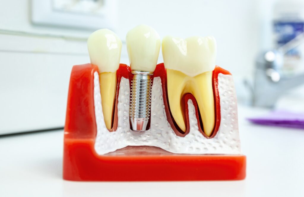 Dental implant being inserted into anatomical model of teeth and gums