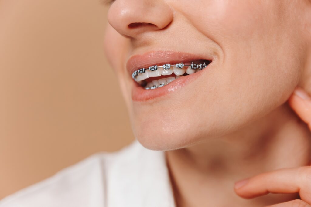 Close-up of a woman with braces on a beige background